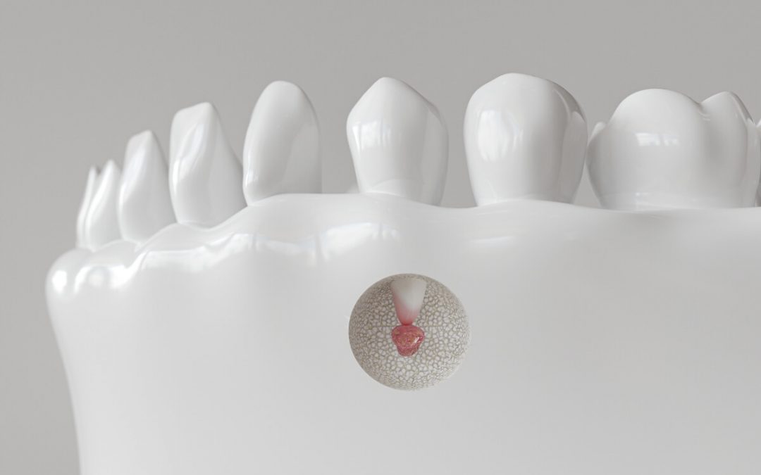 ¿En qué casos se realiza una cirugía periapical?
