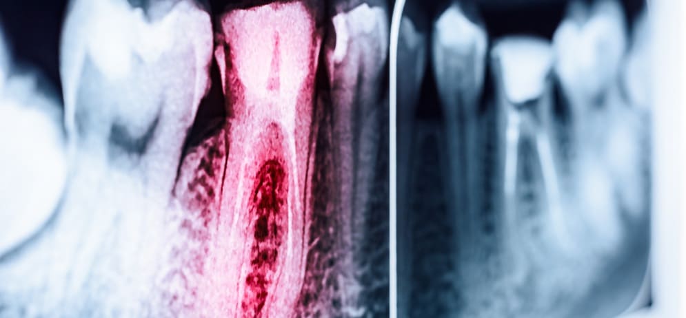 Endodoncia en Lanzarote en la clínica dental Vega Ginory en Arrecife