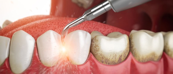 Periodoncia en Lanzarote en la clínica dental Vega Ginory en Arrecife