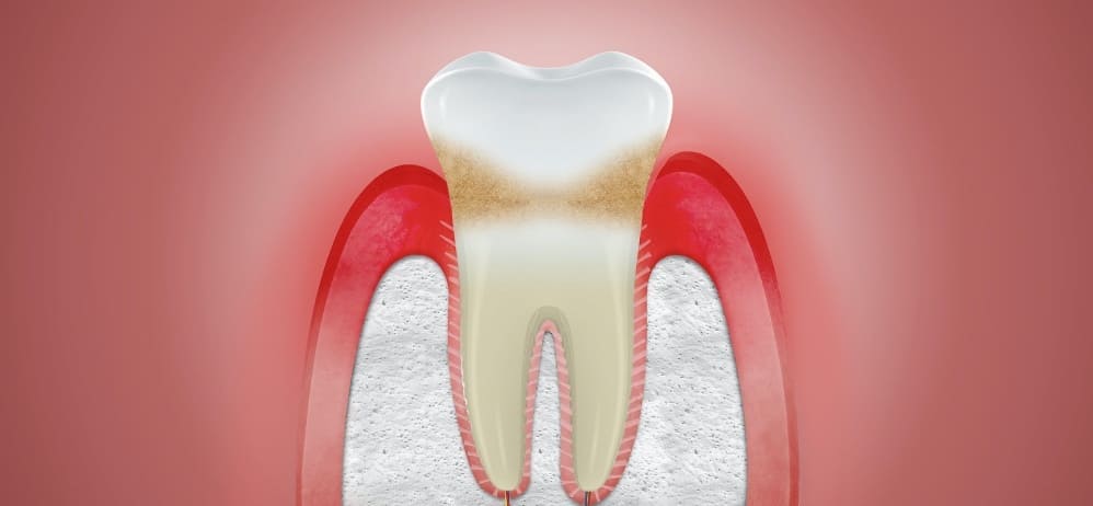 Periodoncia en Lanzarote en la clínica dental Vega ginory en Arrecife