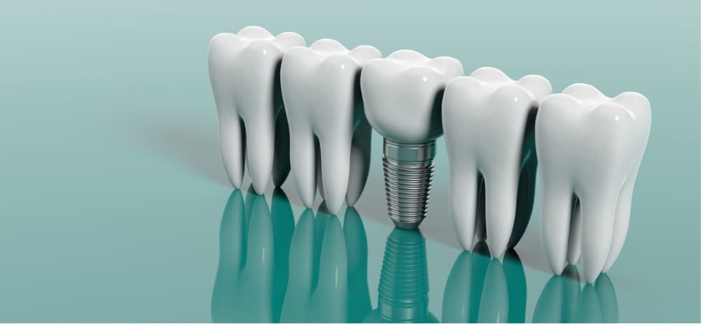 implantes dentales en Lanzarote en la clínica dental Vega ginory en  Arrecife