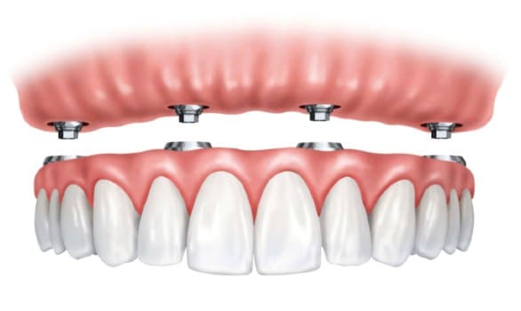 Implantes dentales en Lanzarote en la clínica dental Vega Ginory en Arrecife