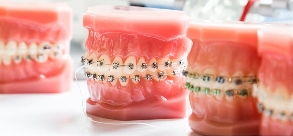 Ortodoncia con brackets Lanzarote en la clínica dental Vega Ginory en Arrecife