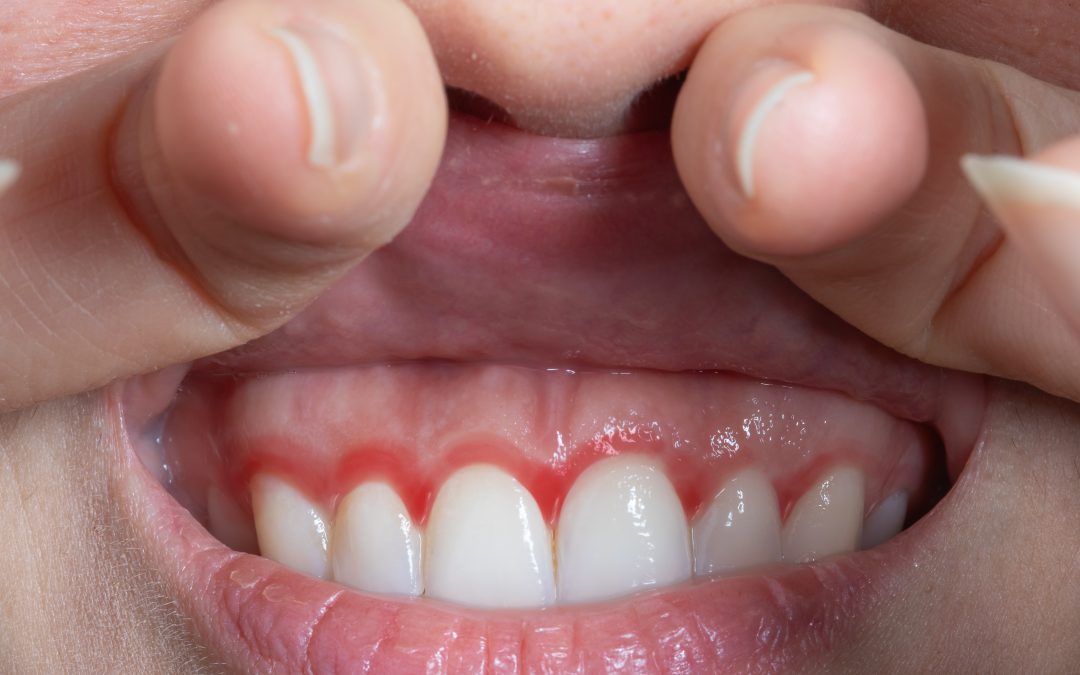 Tipos de periodontitis