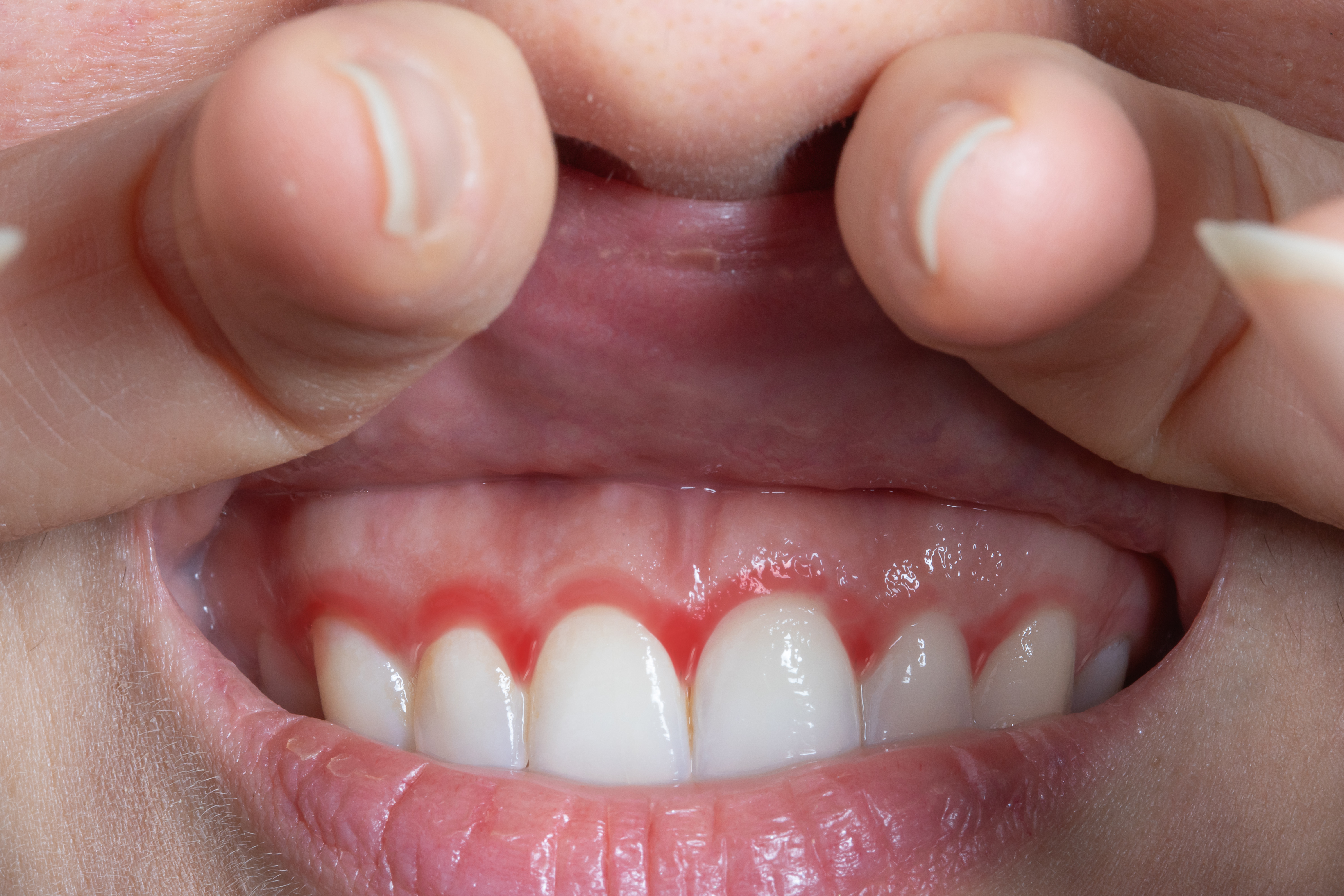 Tipos de periodontitis por la clínica dental Vega Ginory en Lanzarote