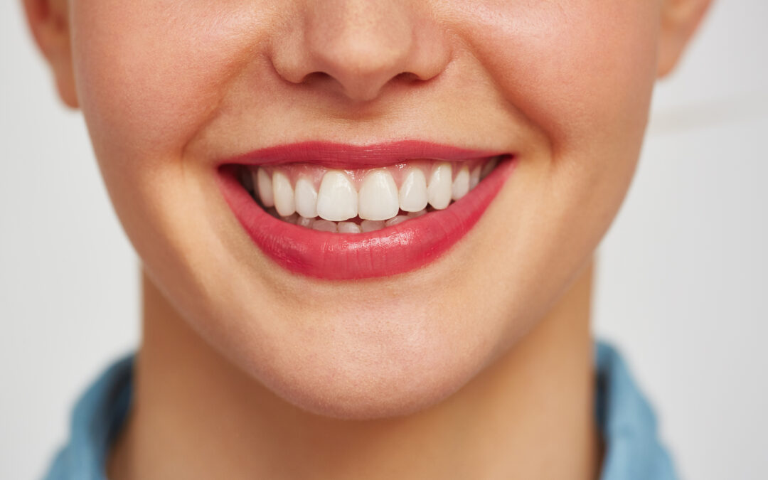 Carillas dentales antes del verano: cuándo son la mejor opción para mejorar tu sonrisa