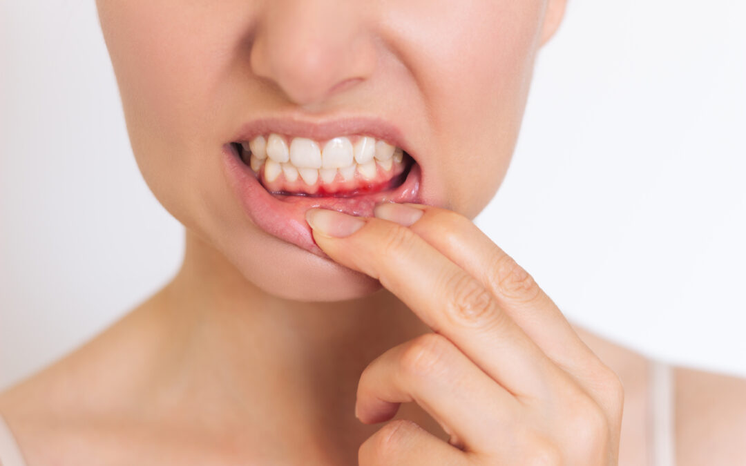 ¿Qué es la periodontitis y cómo saber si necesitas tratamiento?
